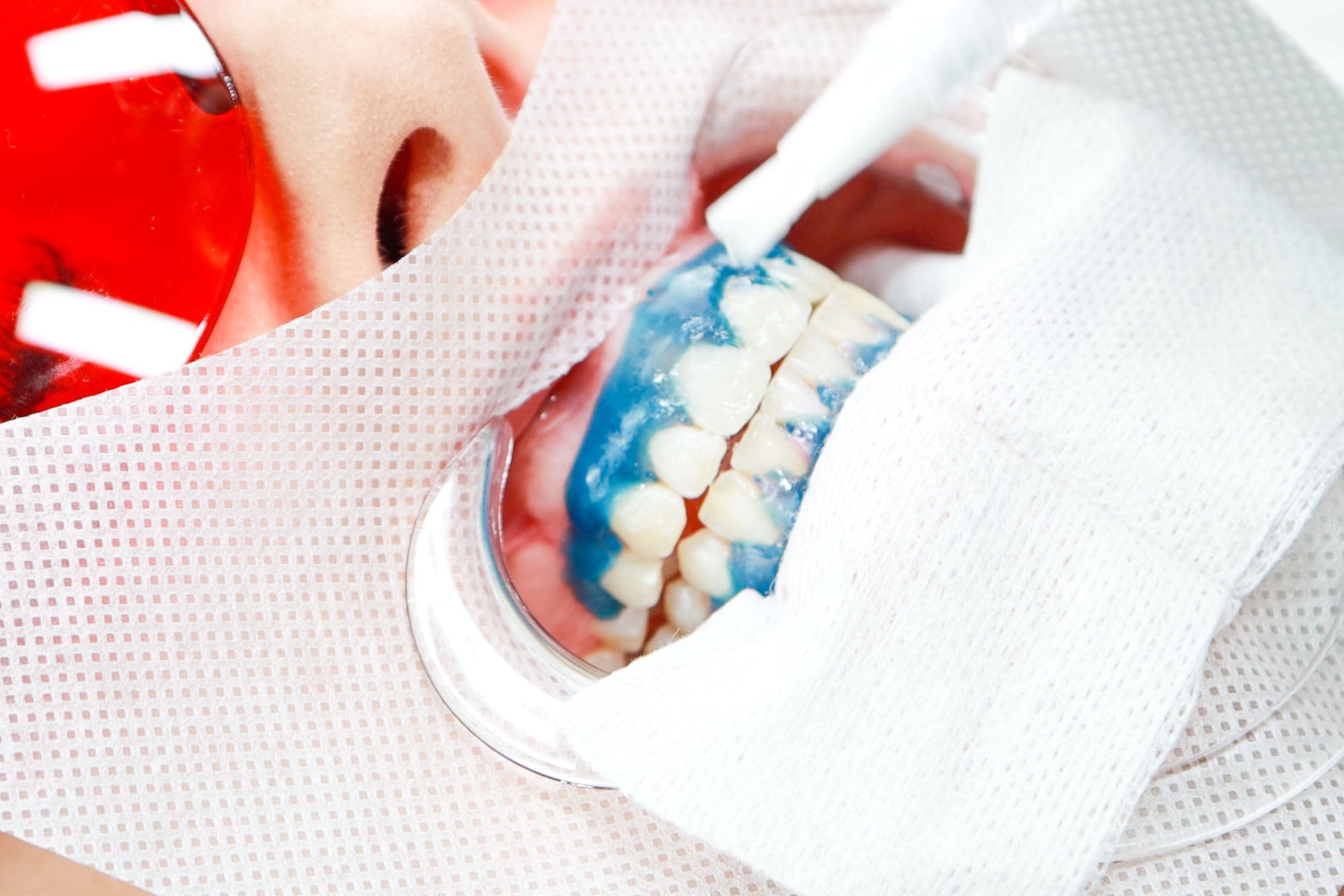 Teeth Whitening Supplies